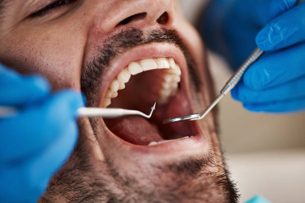 Best Emergency Tooth Extraction in Lewistown, IL